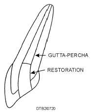 Permanent restoration in place on completedroot canal