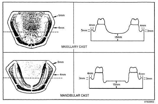 Trimmed maxillary and mandibular cast