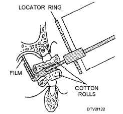 Film and cylinder placement: mandibular molar area