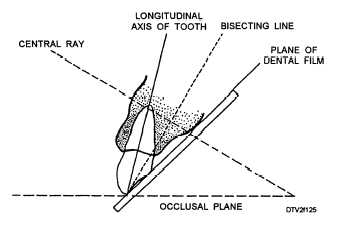 Relationship of central ray, tooth, and film packet in bisecting-angle technic