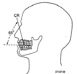 Projection of central ray (CR) for maxillary posterior occlusal radiographs
