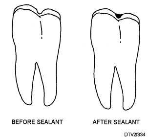 Before and after applying a sealant on a tooth