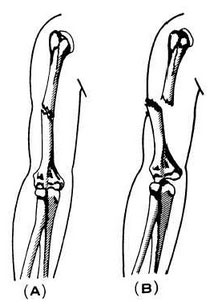 Closed and open fractures