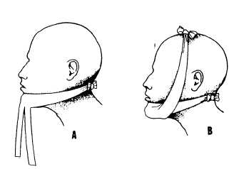 Four-tailed bandage for the jaw