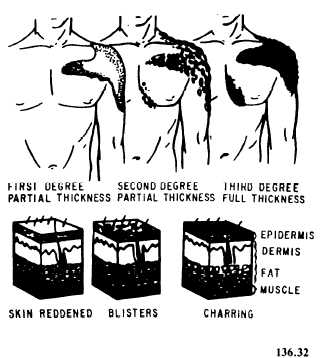 Classification of burns