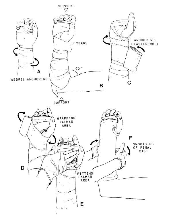 Applying a short arm cast