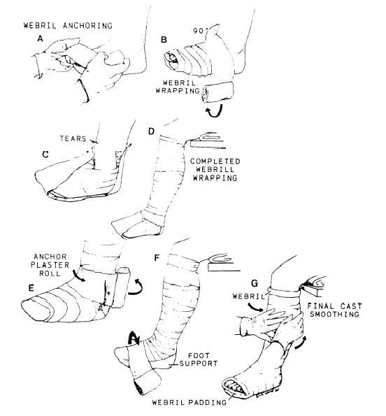 Applying a short leg cast