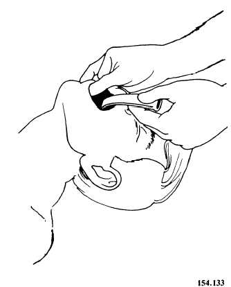 Placement of an oropharyngeal airway