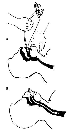 Insertion of esophageal obturator airway