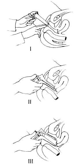 insertion of the vaginal speculum