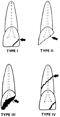 types of tooth fractures
