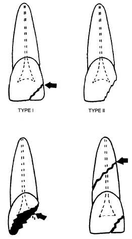 Types of tooth fractures