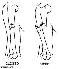 Closed and open fractures