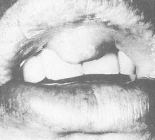 Carcinoma of the upper lip