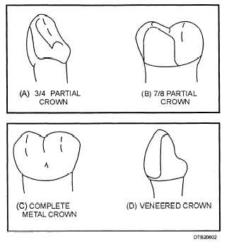 Types of artificial crowns