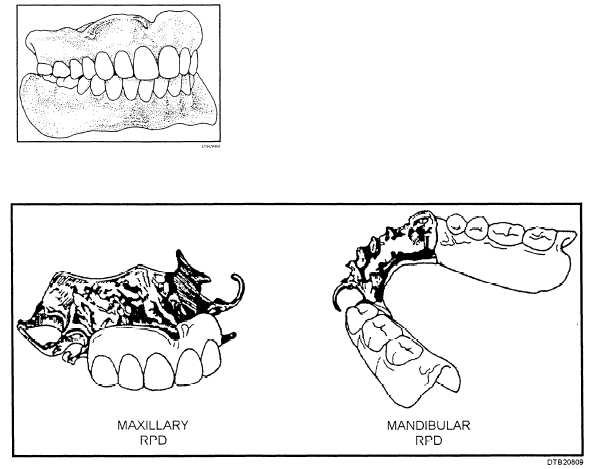 Maxillary and mandibular RPDs