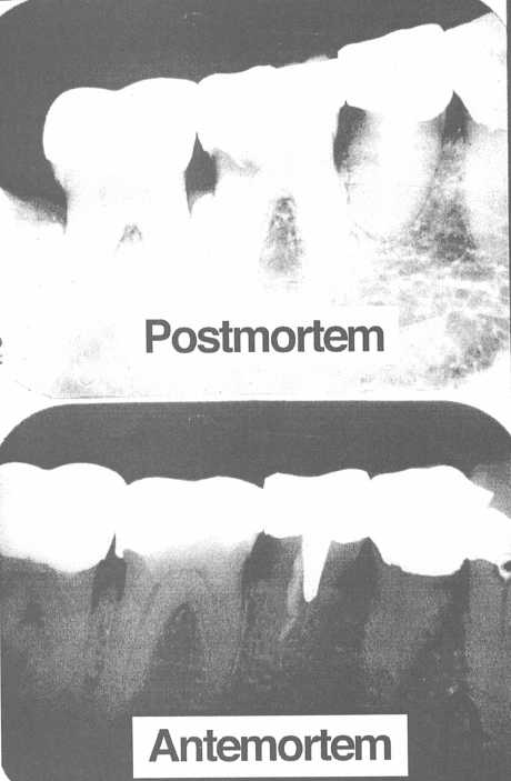 Postmortem and antemortem exact match periapical X-ray