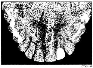Typical maxillary anterior occlusal radiograph