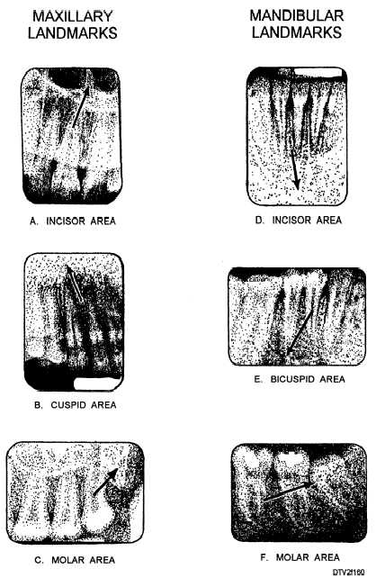 Maxillary and mandibular radiographic landmarks